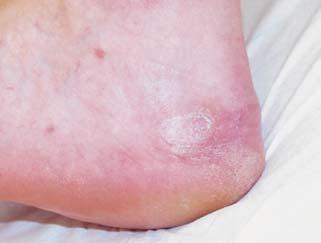 infected superficial wounds are important in order to avoid adverse events.