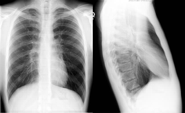 Diagnosis Setting matters Outpatient Symptom assessment CXR usually shows hyperinflation and more translucent lung fields, flattened diaphragm. PFTs Show obstructive pattern. Severity varies.