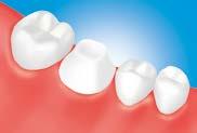 Tooth structure, resin cores, or non-precious metal cores When cementing a prosthesis (such as a laminate veneer