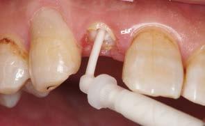 This is why root canals have a reputation of being difficult clinical sites in terms of obtaining a strong bond to tooth structure.