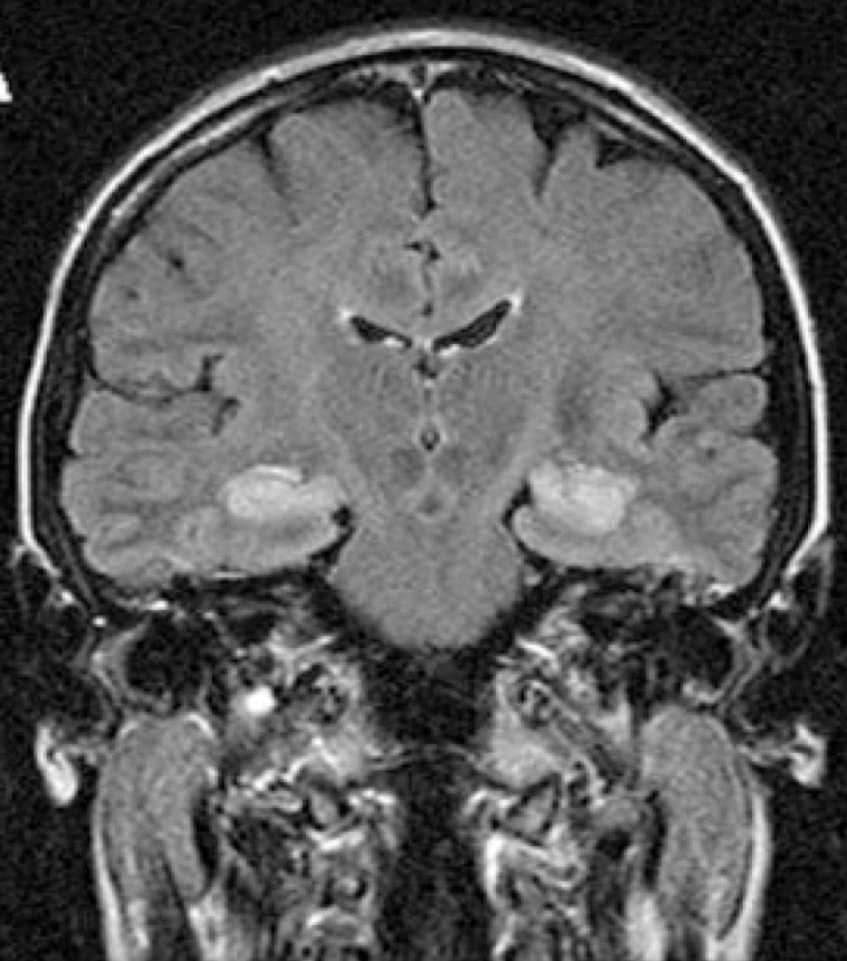 LGI1-antibody limbic encephalitis Later years Subacute onset Amnesia, disorientation Seizures +/- Psychiatric