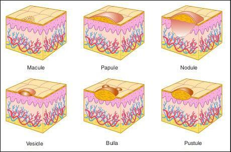 CHARACTERISTICS OF THE LESION: Morphology. Size and shape. Number, location and distribution.
