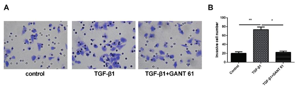 GLI-1 facilitates the EMT induced by TGF-β1 in gastric cancer Figure 4. Blocking GLI-1 inhibits the TGF-β1-induced EMT.