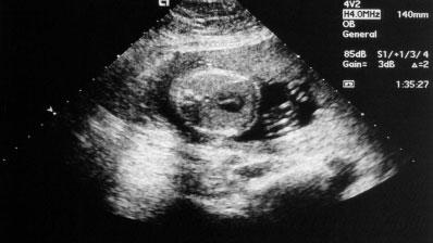 2 Abuhamad Figure 2 Color Doppler ultrasound applied at the level of the four-chamber view during diastole in a fetus at 22 weeks gestation.