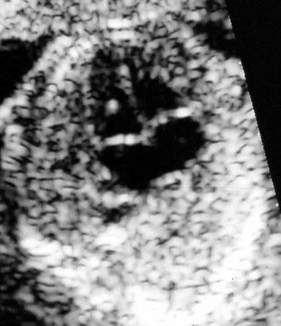 LV, left ventricle; RA, right atrium; RV, right ventricle. Figure 1 (a) A suboptimal ultrasound image of the fetal heart obtained at 18 weeks gestation at the level of the four-chamber view.