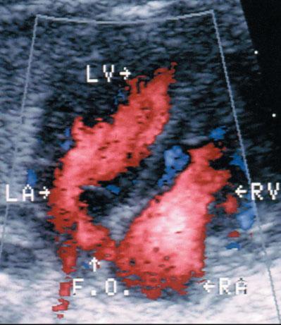 PULSED DOPPLER AND FETAL ECHOCARDIOGRAPHY The Doppler effect describes the apparent variation in frequency of a light or a sound wave as its source approaches or moves away, relative to an observer.