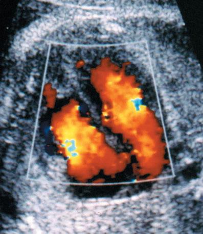 Editorial 3 Figure 3 Color Doppler ultrasound applied at the level of the four-chamber view during diastole.