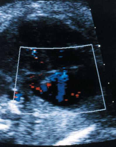 4 Abuhamad Figure 4 Tricuspid regurgitation (TR) detected by color Doppler ultrasound. (a) Transient TR in a normal fetus. (b) TR associated with fetal hypoxemia.