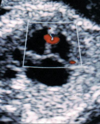 Editorial 5 Figure 7 Color Doppler ultrasound of the three-vessel view obtainedat21weeks gestationinafetuswithsevereaortic stenosis. Note the presence of retrograde flow in the aorta (red).
