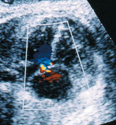 Figure 6 Color Doppler ultrasound confirming the presence of restricted flow across the foramen ovale in a fetus at 23 weeks gestation.