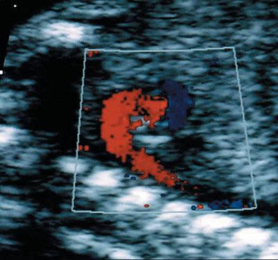 6 Abuhamad Figure 8 Color Doppler ultrasound applied at the level of the aortic arch in a sagittal view of a fetus at 20 weeks gestation with