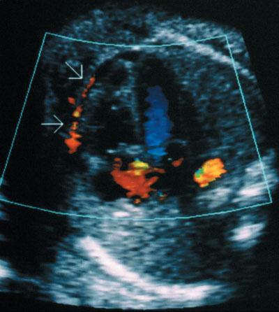 (a) The pericardial fluid (arrows) is seen moving towards the apex during systole.