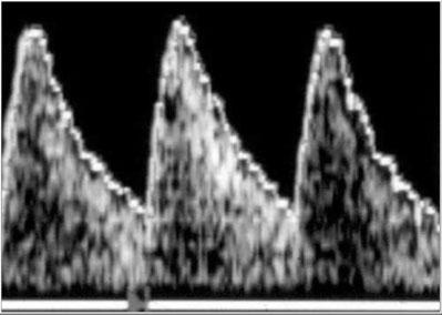 Editorial 7 Figure 10 Peak velocity represents the maximum velocity achieved by the Doppler waveforms. It is expressed in cm/s and is typically obtained at the aortic and pulmonary valves.