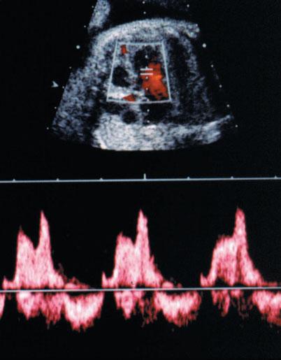 These Doppler waveforms are biphasic in shape with the first phase (E-wave) corresponding to fast ventricular filling and the second phase (A-wave) corresponding to the atrial kick.