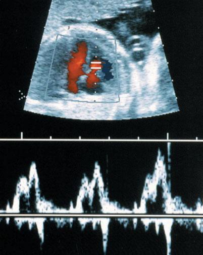 Am J Cardiol 1997; 79: 173 177. 9. Ben-Ami M, Peleg D, Haddad S, Perlitz Y. Normal cardiac flow velocities at 14 16 weeks gestation measured by transvaginal ultrasound.