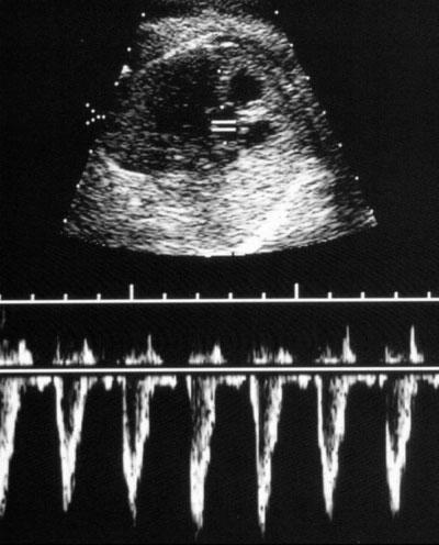 Editorial 9 Figure 15 Doppler waveforms obtained across the aortic (a) and pulmonary (b) valves. These Doppler waveforms are uniphasic in shape.