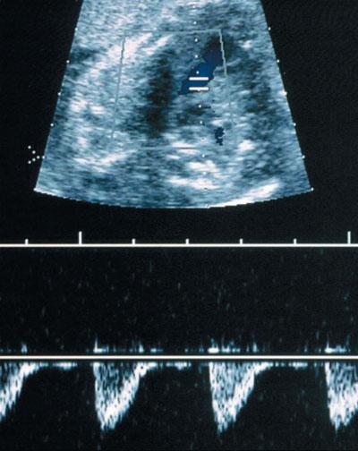 Acceleration time in the aorta and pulmonary artery measured by Doppler echocardiography in the midtrimester normal human fetus. Br Heart J 1987; 58: 15 18. 14.