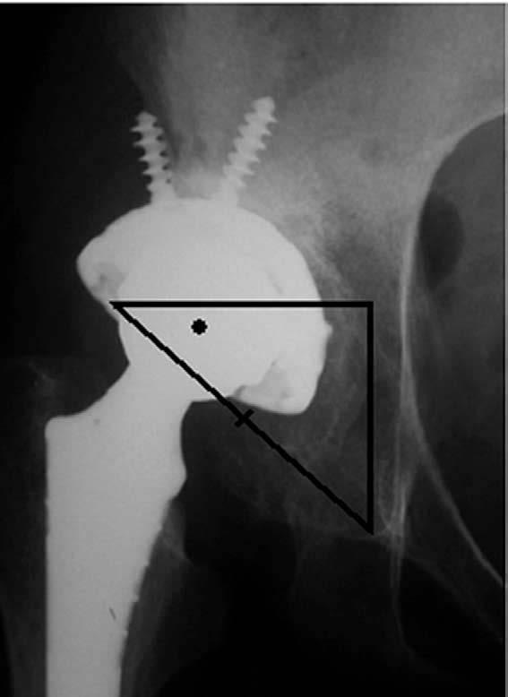 244 The Journal of Arthroplasty Vol. 24 No. 2 February 2009 that this technique may be associated with a high incidence of collapse of the graft [10].