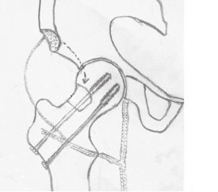 Ascending branch of lateral femoral circumflex artery 3. Opening window at head neck 4. Cannulated compression screws Fig. 2 Diagrammatic representation of the operative technique. Fig. 3a Fig.