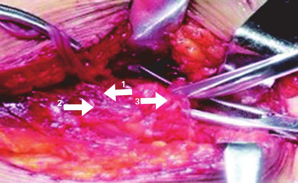 harvesting vascularised iliac bonegraft (arrow). were treated between January 2000 and December 2009. There were 18 women and 16 men, with a mean age of 38.