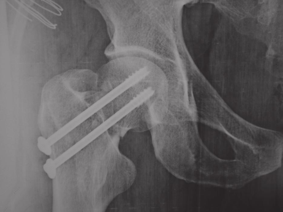 c) bone healing one year after removal of the cannulated screws (lateral view radiographs not available). femoral neck in order to protect the basilar section of the arterial ring.