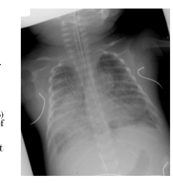 PRIMARY TB DISEASE Typical of childhood TB Usually not cavitary Classic