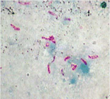 TB CULTURES FROM CHILDREN Bronchoalveolar lavage (BAL) Single specimen with similar yield to 3 GA s Sensitivity 40% (20-50% range) Lymph nodes Biopsy or FNA for path and culture Sensitivity 30-70% on