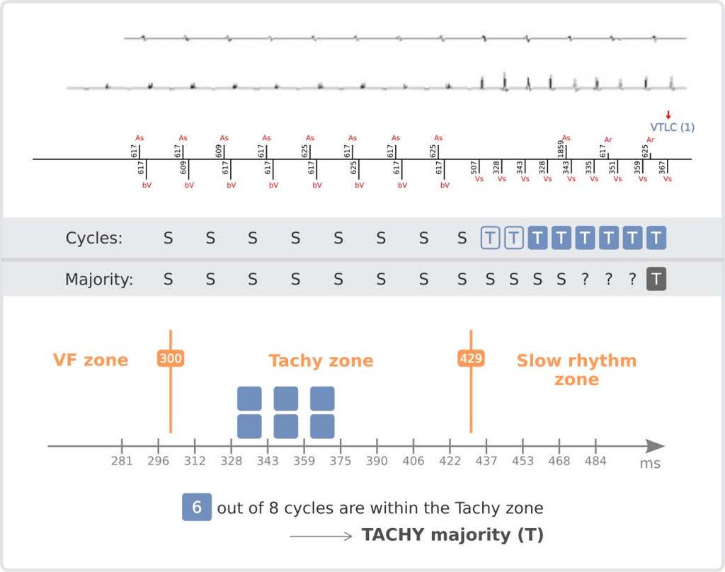 TACHYCARDIA Majority For a given rhythm to be labelled as a Tachycardia majority rhythm, at least 6 out of the last 8 ventricular cycles must have been classified as a Tachycardia cycle.