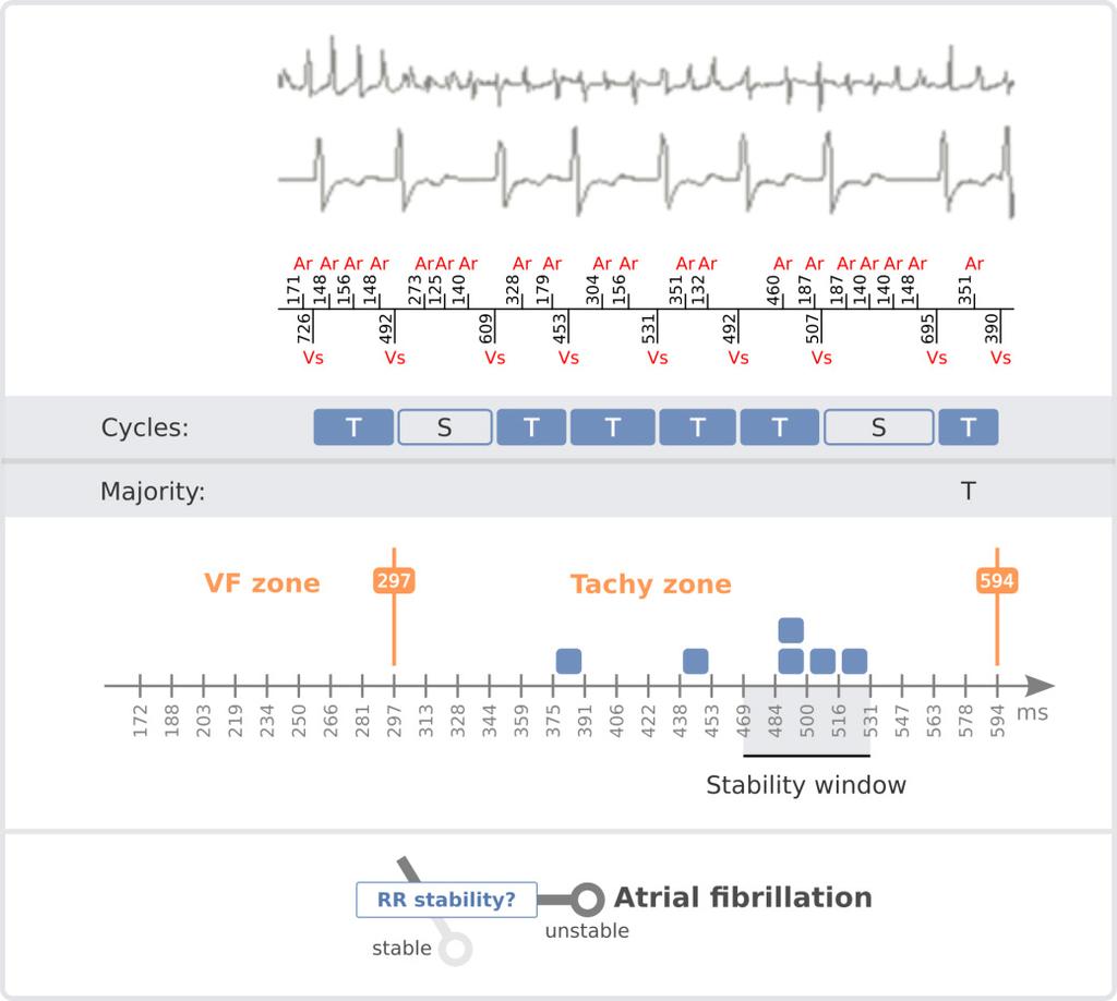 An illustration of a rhythm labeled as having SVT majority (upon cycle 8) is given below: Figure 4 Here the programmed zones are: VF zone = 200 bpm, VT zone = 100 bpm.