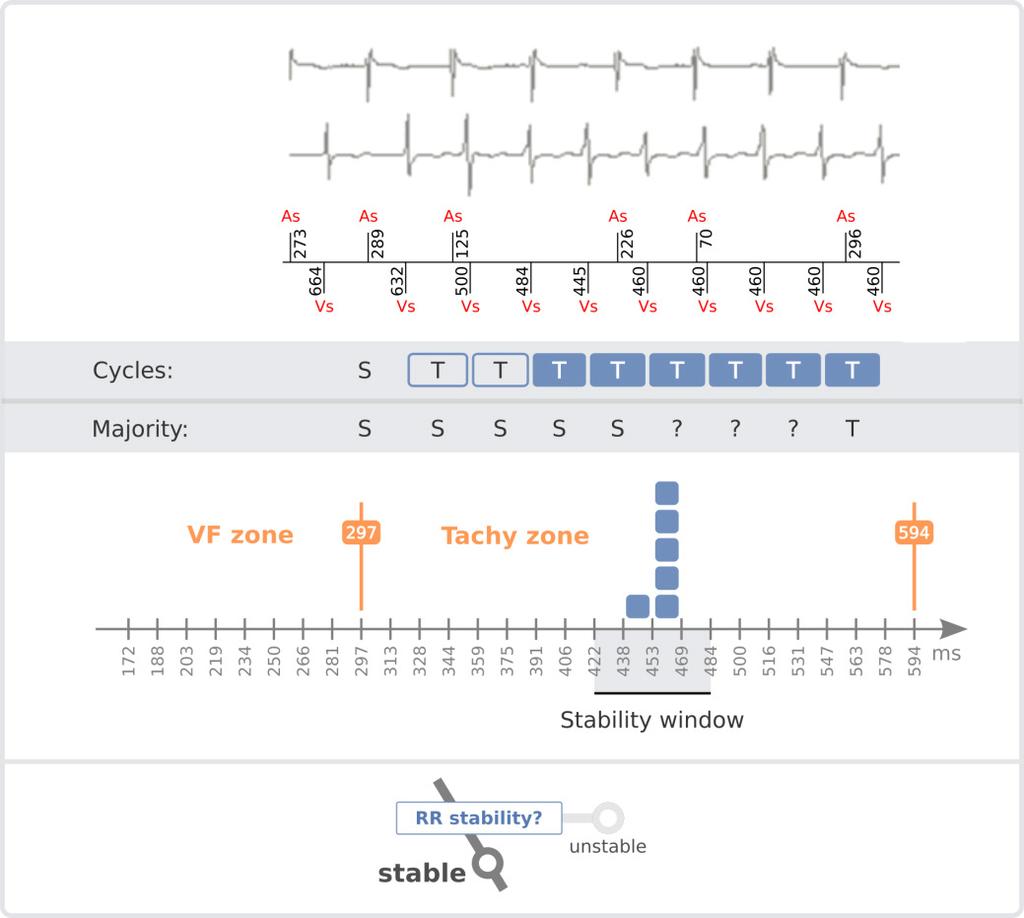 An illustration of a rhythm reaching TACHYCARDIA majority (upon cycle 8) is given below: Figure 5 - In this example, among the last 8 cycles, the first 2 cycles are excluded from the analysis (onset