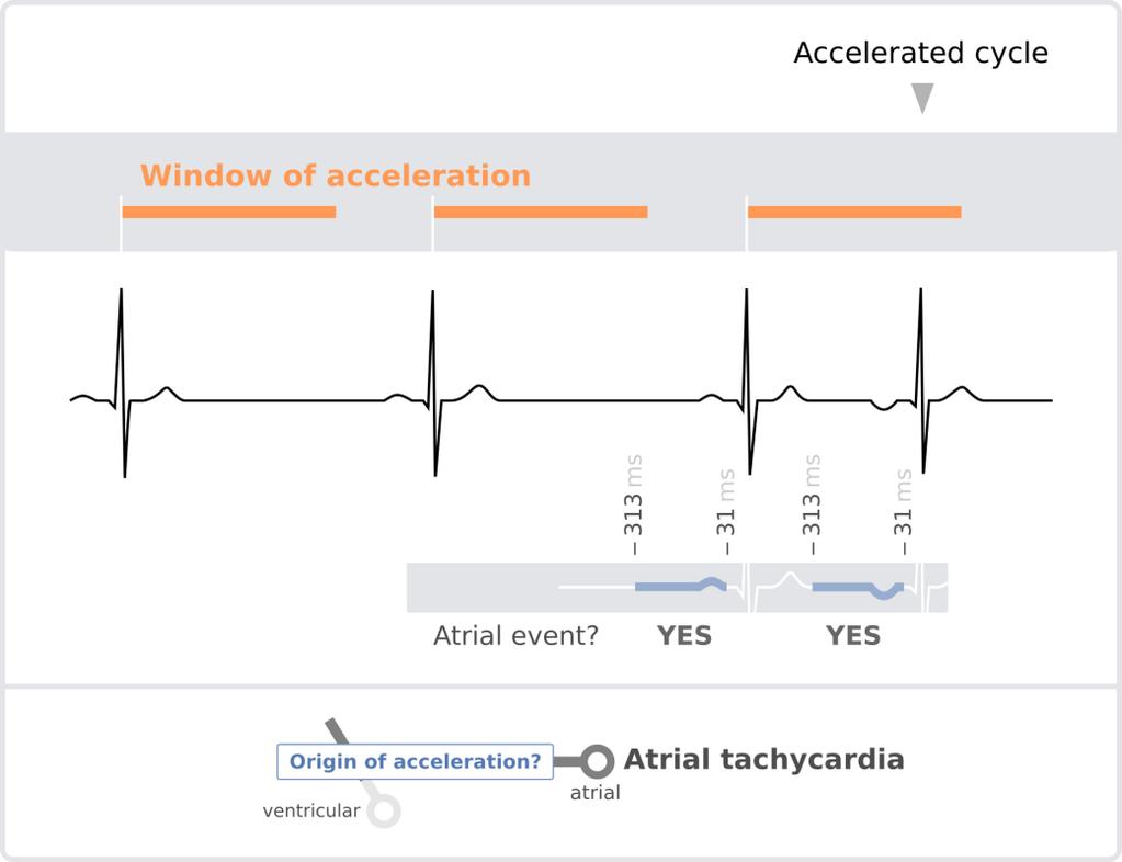 A conducted ventricular beat is a ventricular event preceded by an atrial event occurring in a time range of [31 ms