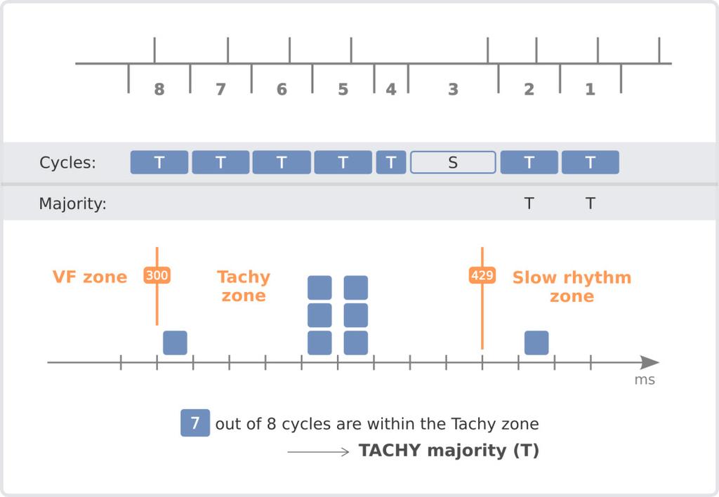 Stability analysis Reminder: A rhythm with a Tachy majority is considered stable if at least 75% (programmable