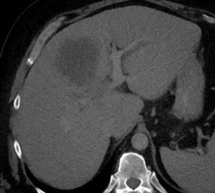 Obstructive Jaundice Liver Injury with CBD stone (Choledocolithiasis)