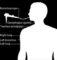 Bronchoscopy is a procedure that allows the doctor to look into the airways of your lungs. A flexible tube (bronchoscope) is passed into your windpipe (trachea) via your nose or mouth.