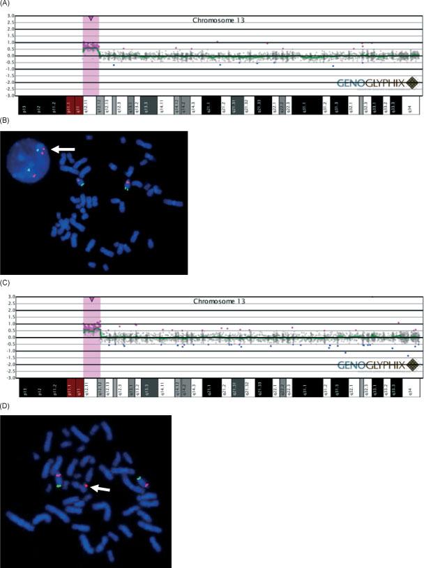 240 T.-H. BUI et al. Figure 4 Microarray and fluorescence in situ hybridization (FISH) results for a gain of 13q11q12.12 in two cases. (A) Microarray result showing a 4.6-Mb gain of proximal 13q.