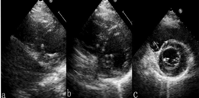 Assessment of right ventricular contraction by speckle tracking echocardiography in pulmonary hypertension patients Figure 2. Right ventricle was crescent from the short-axis view.