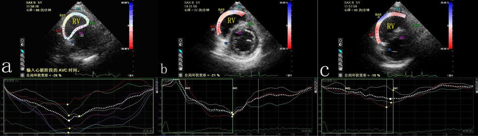 right triangular area in the basal plane (c). that the RV circumferential length is shortened at the systolic period.
