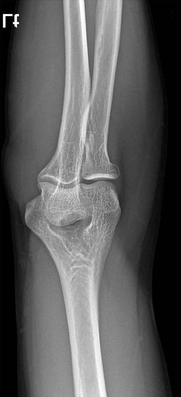 orrective osteotomy was scheduled for correction of the cubitus varus deformity.