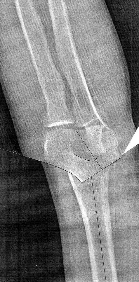 the HEW angle of the affected and the normal elbow.