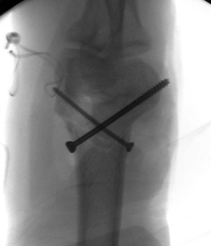 () Intraoperative photo after fixation with two crossing screw.