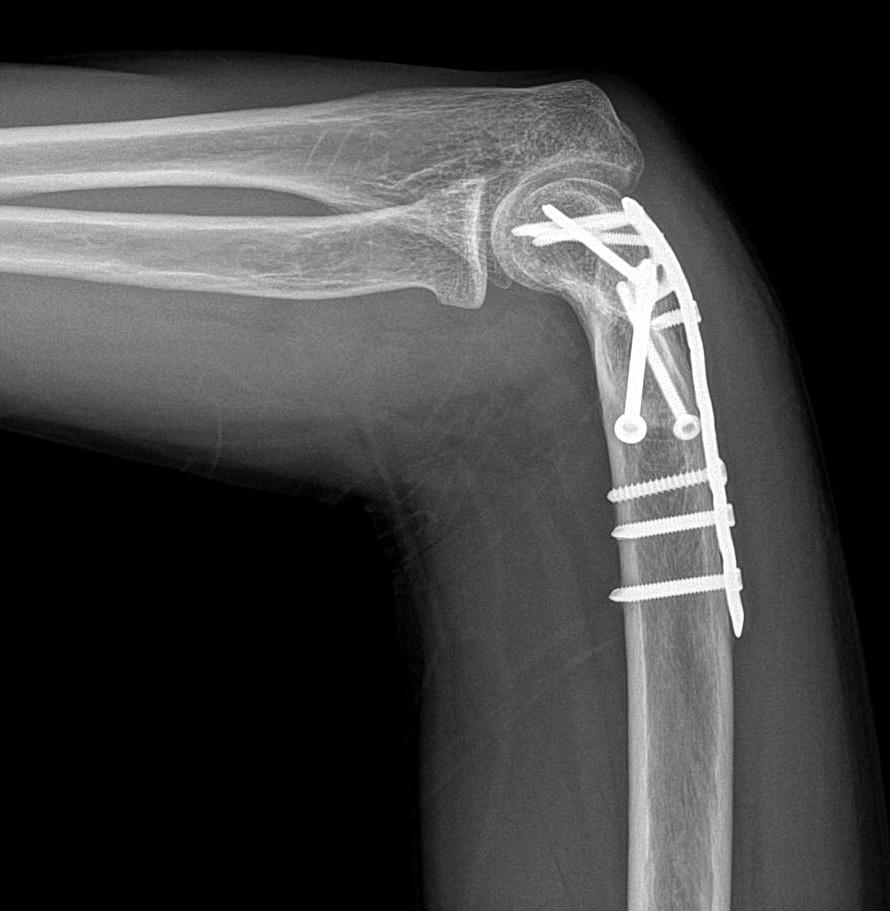 Union was defined as the absence of pain and the presence of a bridging callus in 3 of the 4 cortices seen on the anteroposterior and lateral radiographic views.
