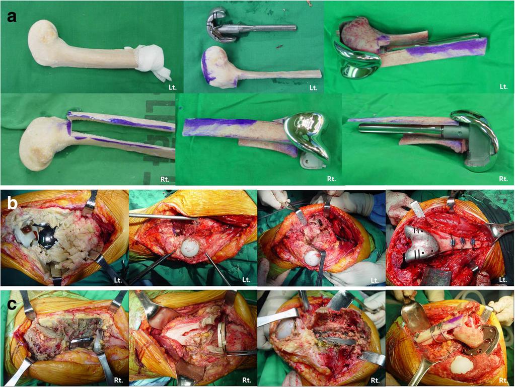 Lee et al. BMC Musculoskeletal Disorders (2018) 19:69 Page 4 of 6 internal fixation was performed using a screw (Fig.