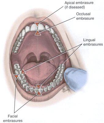 Embrasures function to: Prevent food impaction Reduce occlusal trauma Self-