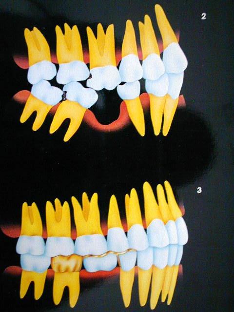 Proximal contact areas Contact areas are on the mesial and distal surfaces of teeth where one tooth touches it s