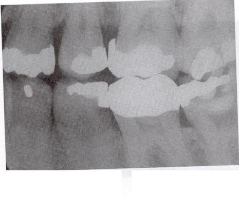 Overhangs, if present, may be detected on dental