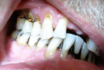 Recession of the gingiva due to disease opens this space to bacteria, food and debris.