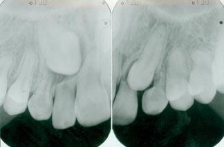 Impacted a tooth that is not completely erupted
