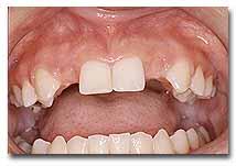 Congenitally Missing condition in which the tooth never
