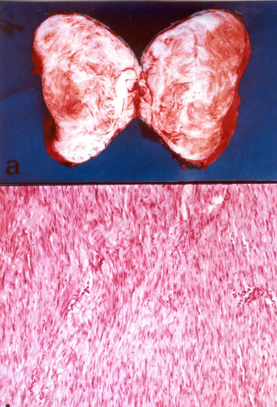 a (a) Cross section of the excised fibroma showing white wavy