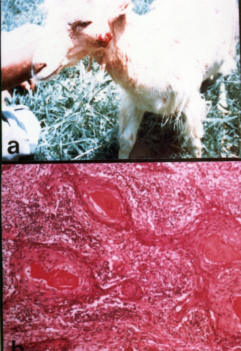 a (a) Squamous cell carcinoma under the base